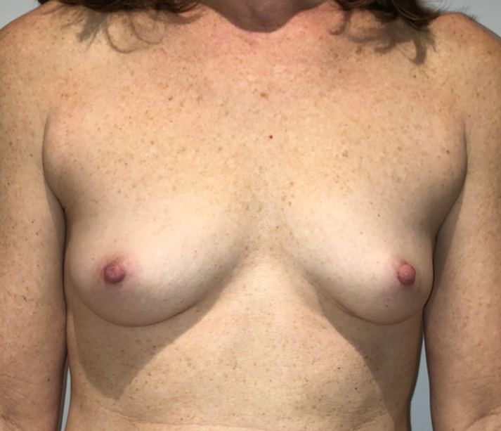Before Image: Breast Augmentation - front