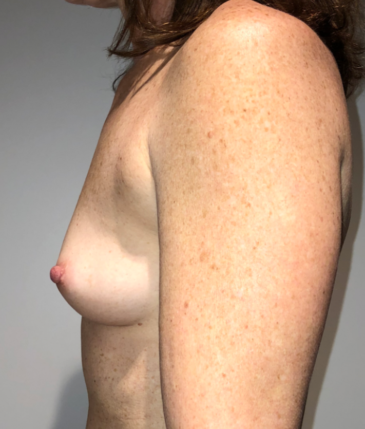 Before Image: Breast Augmentation - left-side
