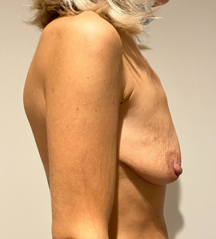 Before Image: Breast Lift and Reduction - right-side