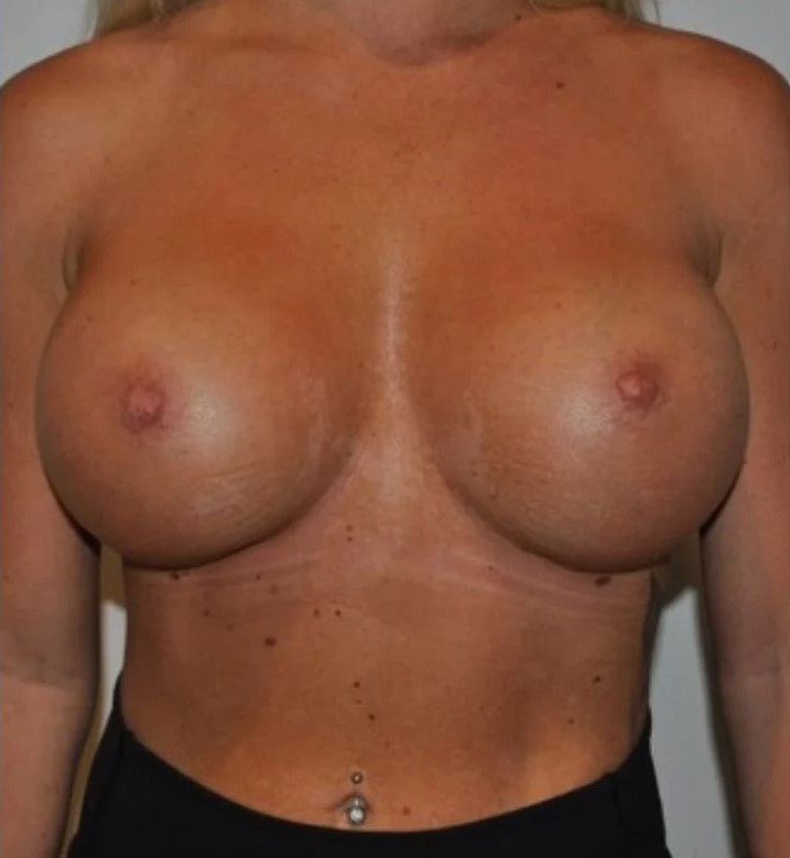 After Image: Breast Augmentation - front