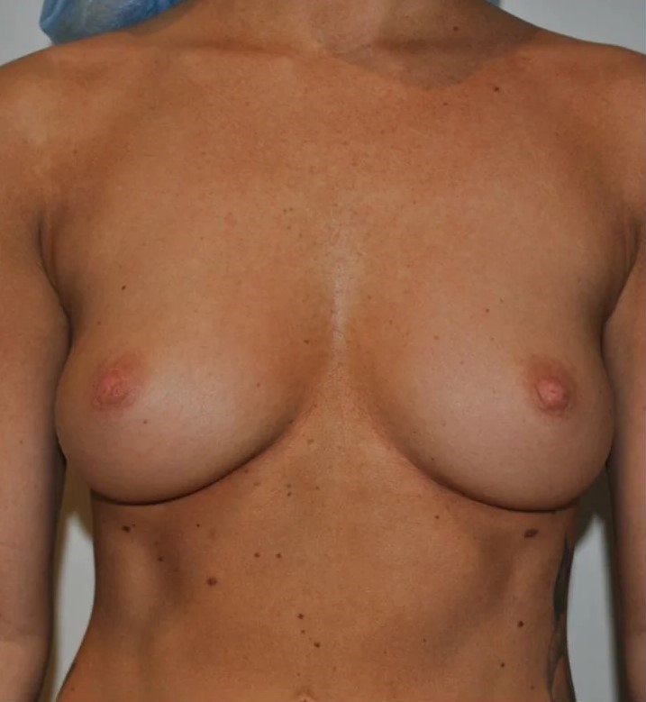 Before Image: Breast Augmentation - front