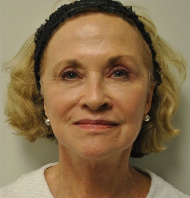 After Image: Surgical Lip Lift - front