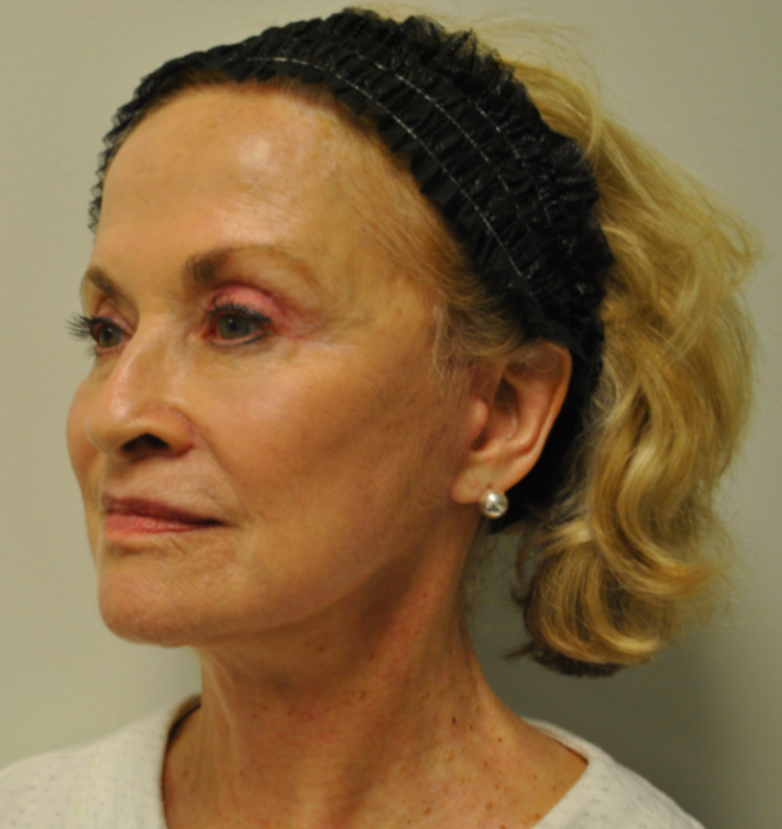 After Image: Surgical Lip Lift - left-front-oblique