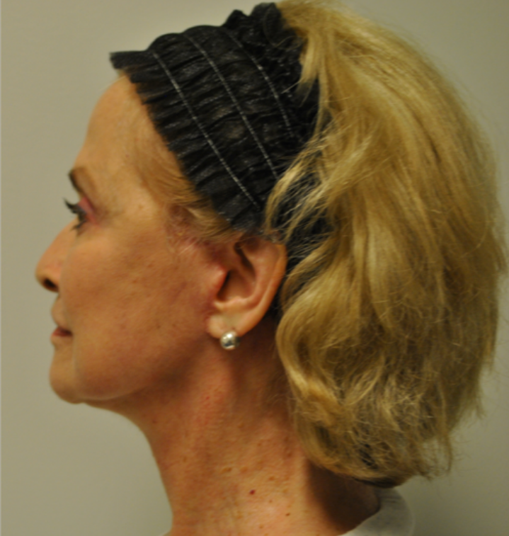 After Image: Surgical Lip Lift - left-side