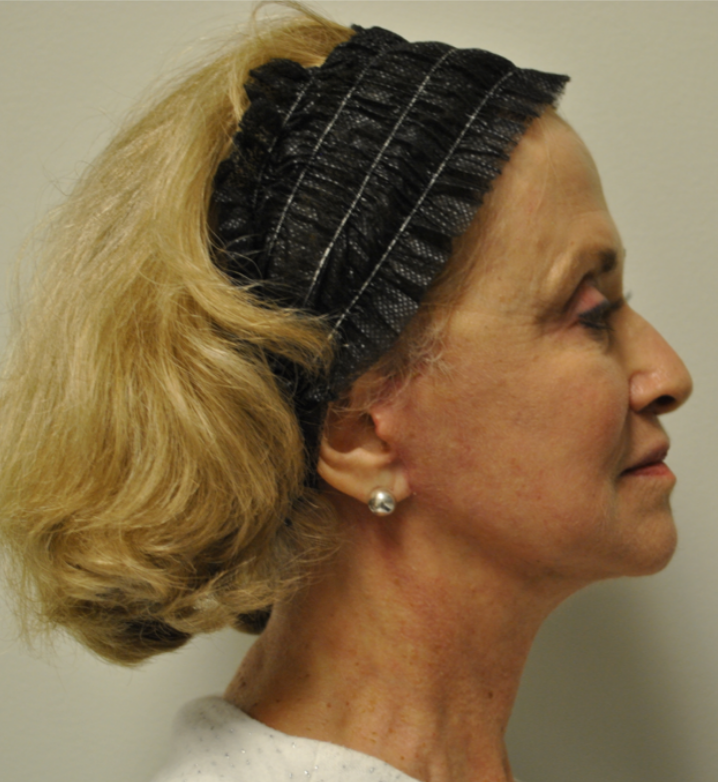 After Image: Surgical Lip Lift - right-side