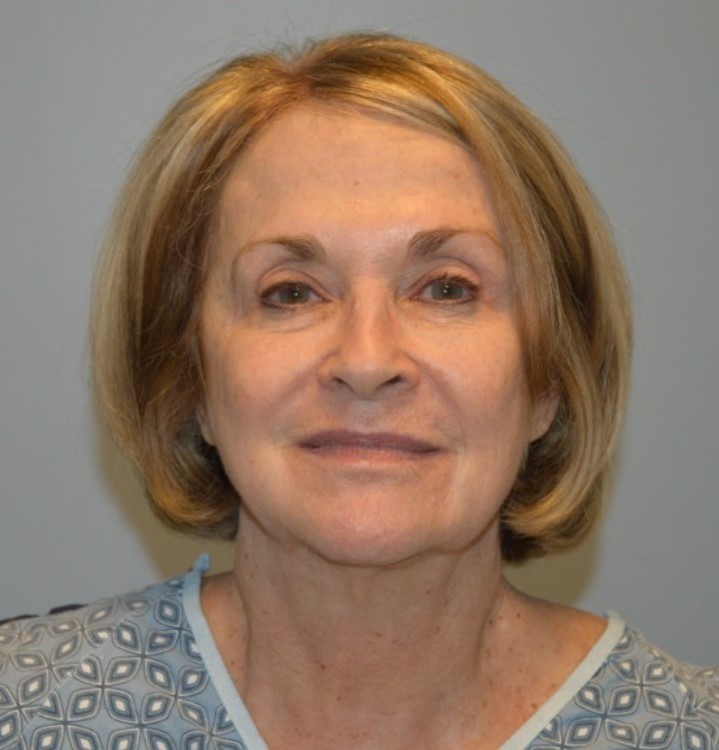 Before Image: Surgical Lip Lift - front