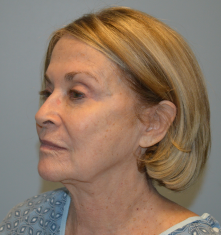 Before Image: Surgical Lip Lift - left-front-oblique