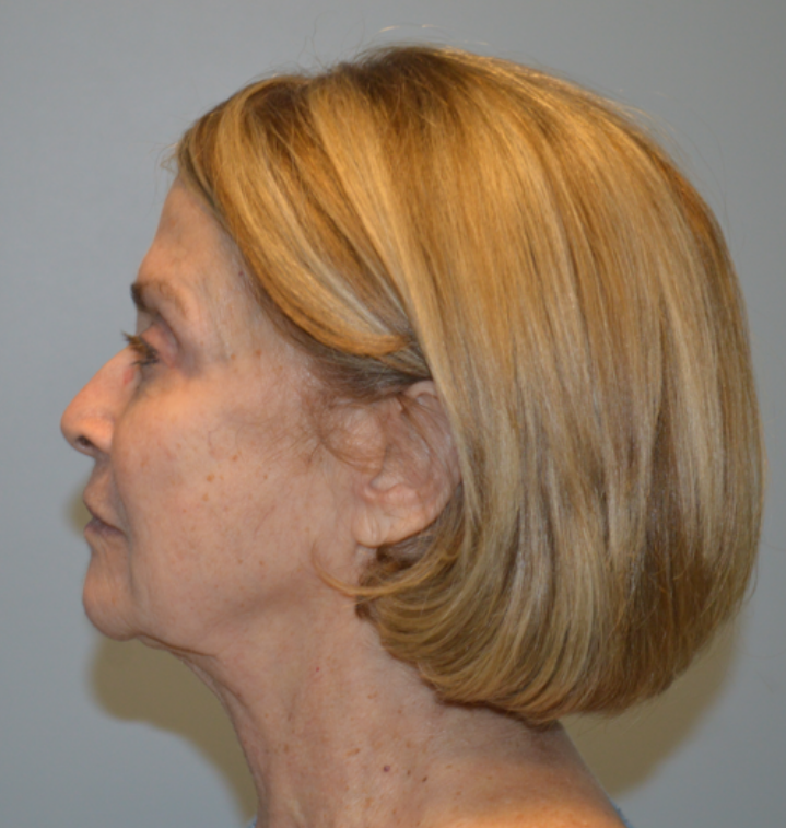 Before Image: Surgical Lip Lift - left-side