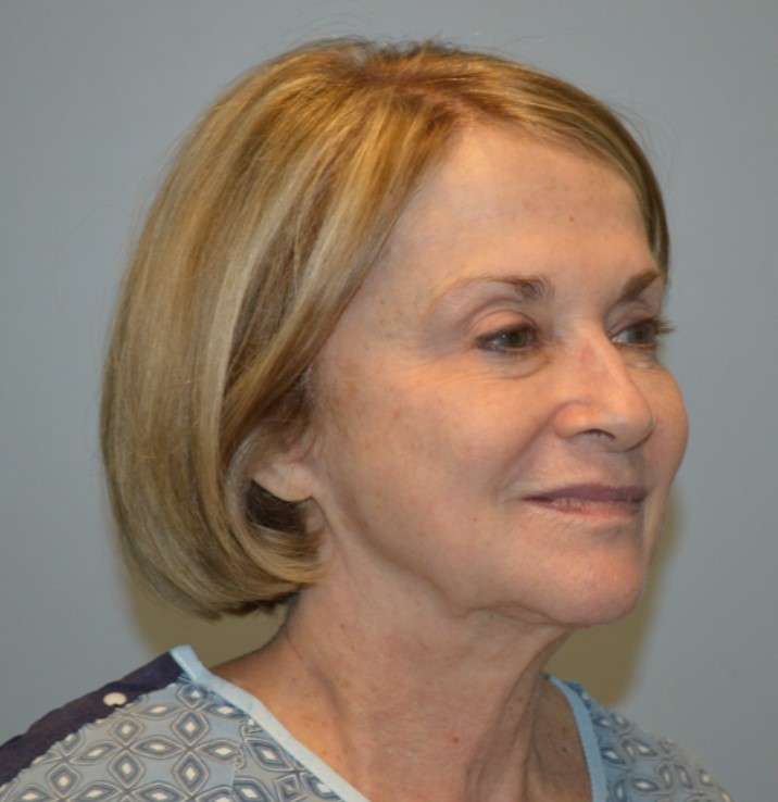 Before Image: Surgical Lip Lift - right-front-oblique