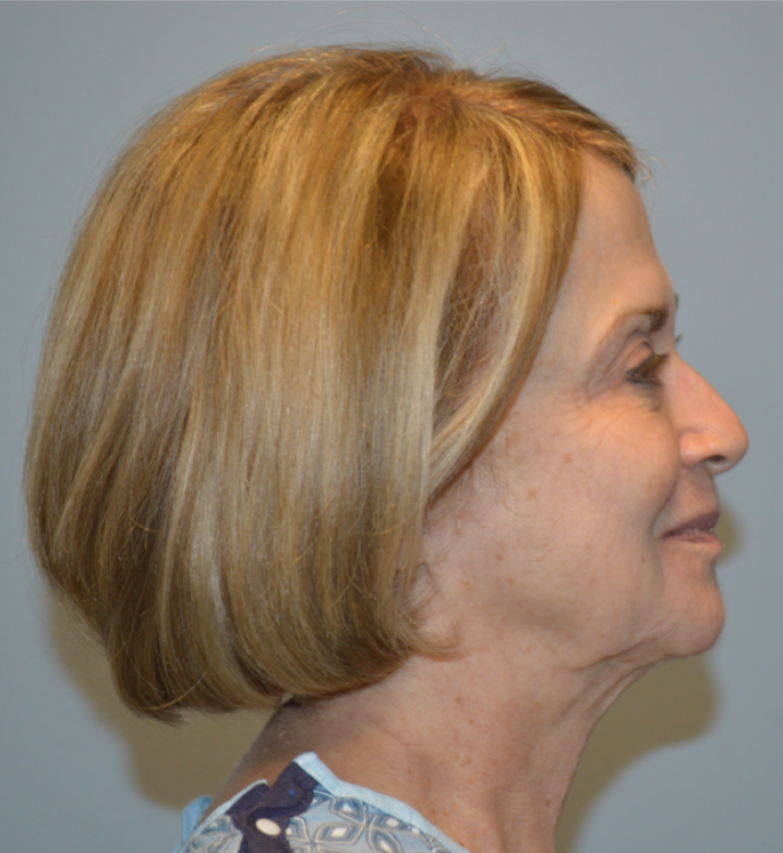 Before Image: Surgical Lip Lift - right-side