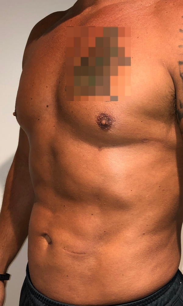 After Image: High Definition Liposuction - left-front-oblique