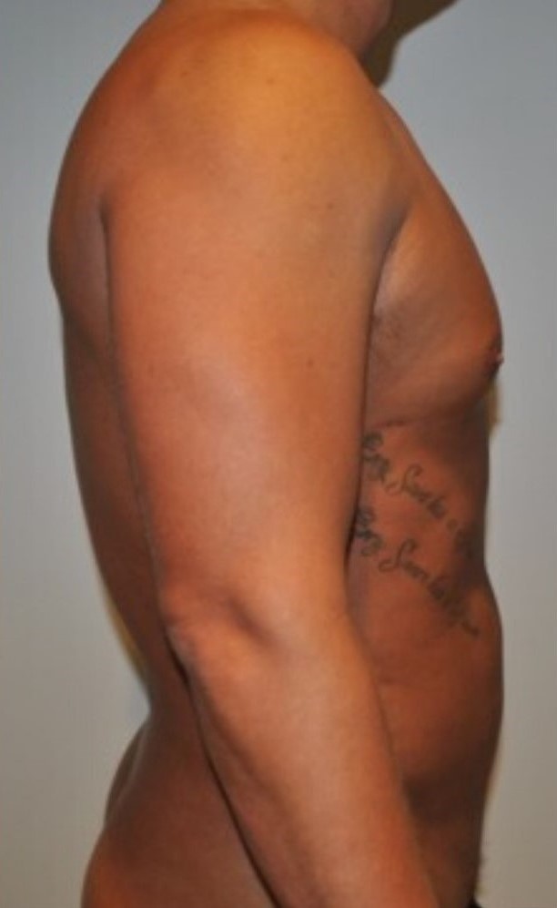 After Image: High Definition Liposuction - right-side