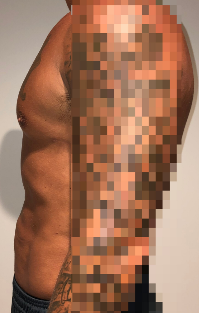 After Image: High Definition Liposuction - left-side