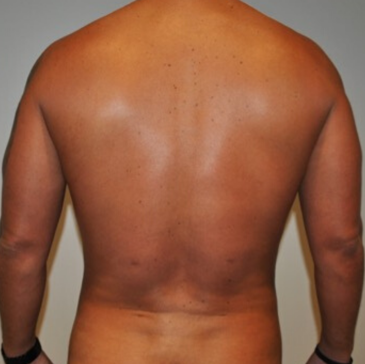 After Image: High Definition Liposuction - back