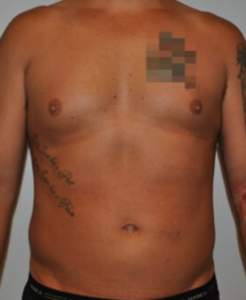 Before Image: High Definition Liposuction