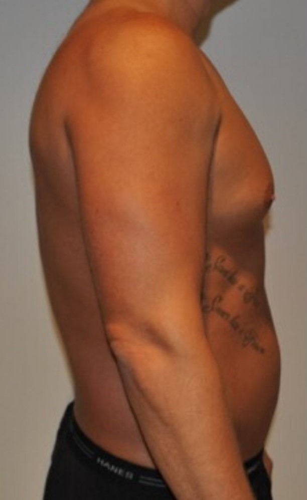 Before Image: High Definition Liposuction - right-side