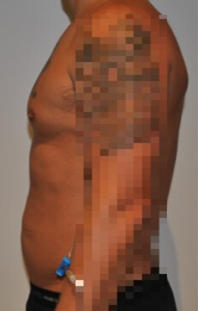 Before Image: High Definition Liposuction - left-side