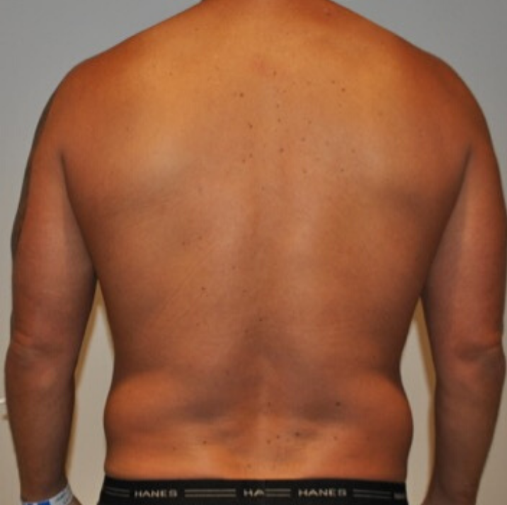 Before Image: High Definition Liposuction - back