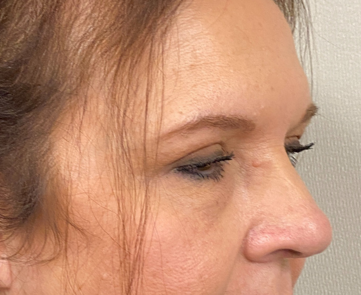 After Image: Blepharoplasty - right-front-oblique