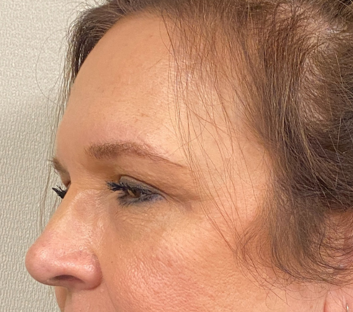 After Image: Blepharoplasty - left-front-oblique