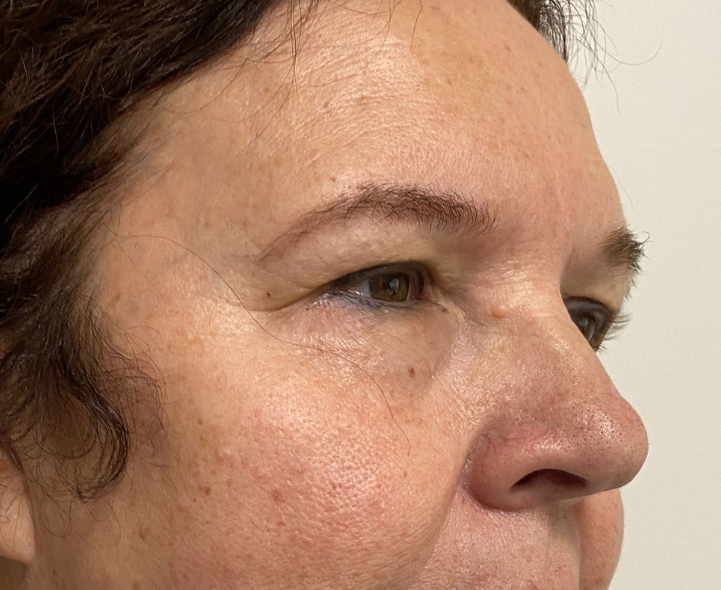 Before Image: Blepharoplasty - right-front-oblique