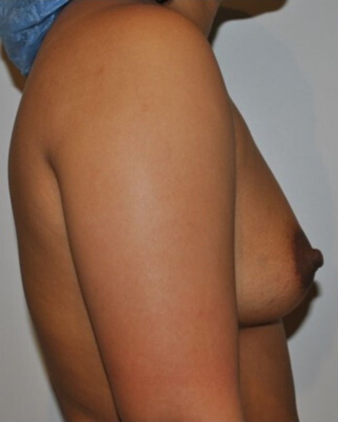 Before Image: Breast Augmentation - right-side
