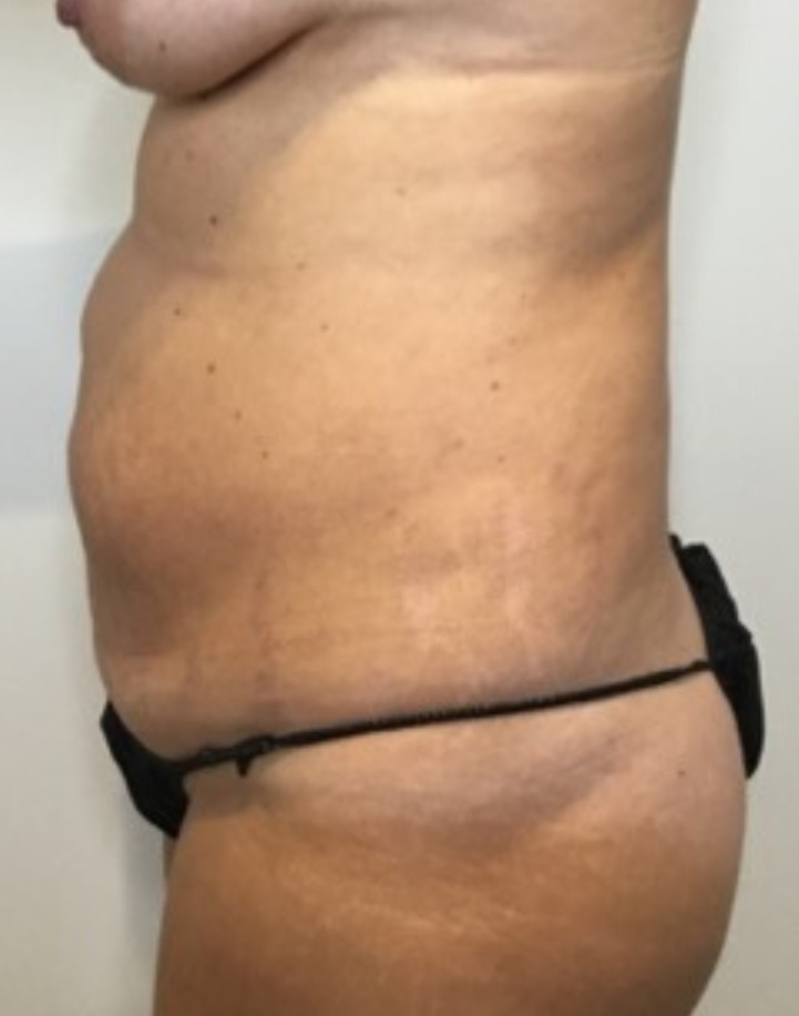 Before Image: Tummy Tuck - left-side