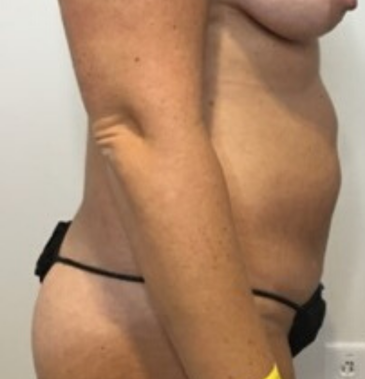 Before Image: Tummy Tuck - right-side