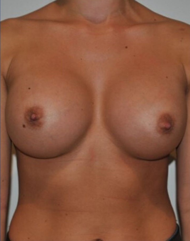 After Image: Breast Augmentation - front