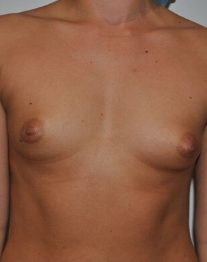 Before Image: Breast Augmentation - front