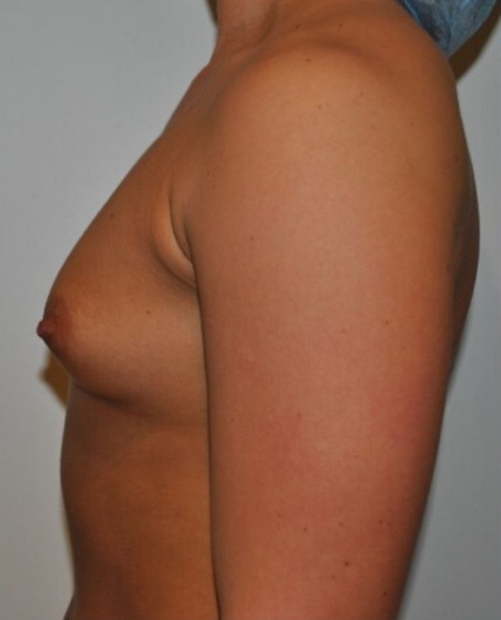 Before Image: Breast Augmentation - left-side