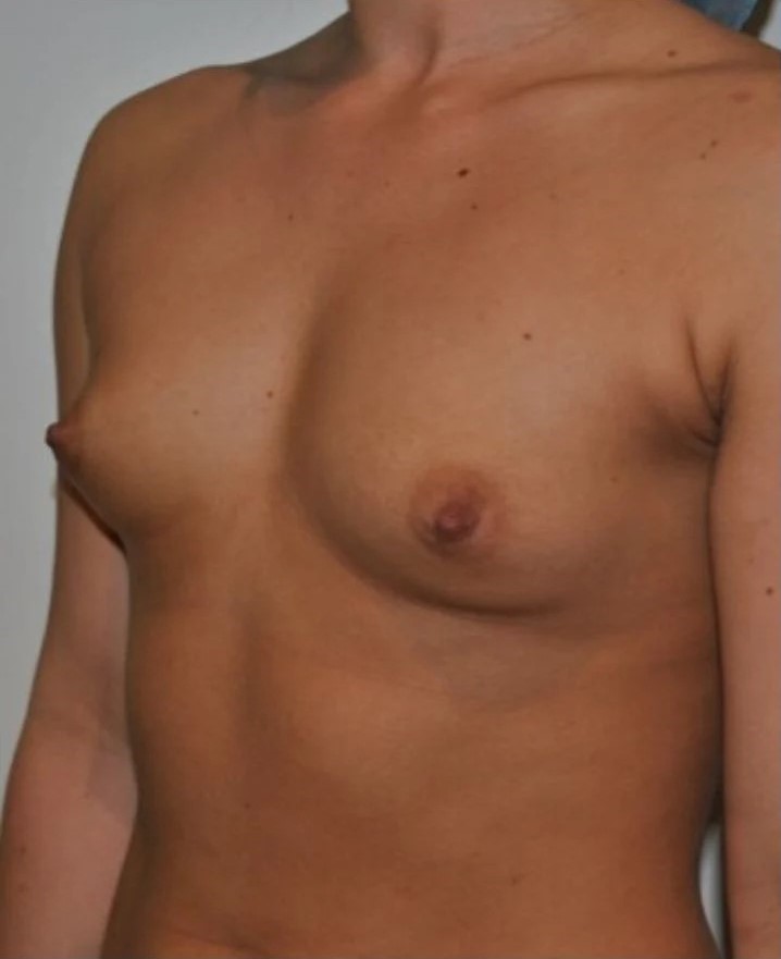 Before Image: Breast Augmentation - left-front-oblique