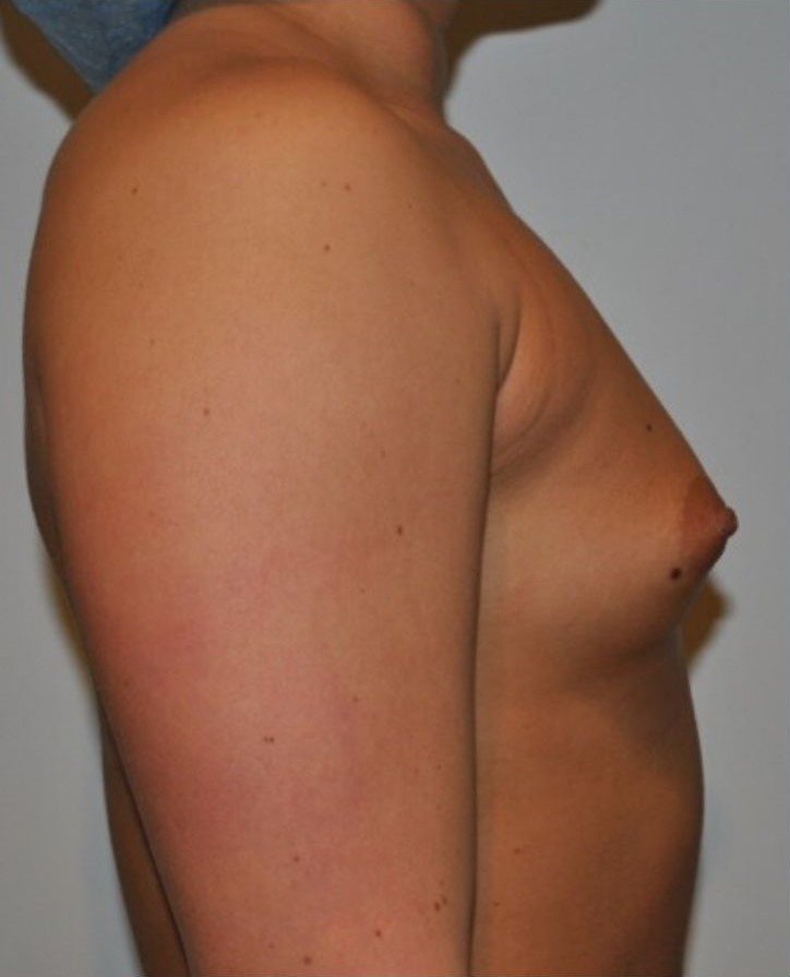 Before Image: Breast Augmentation - right-side