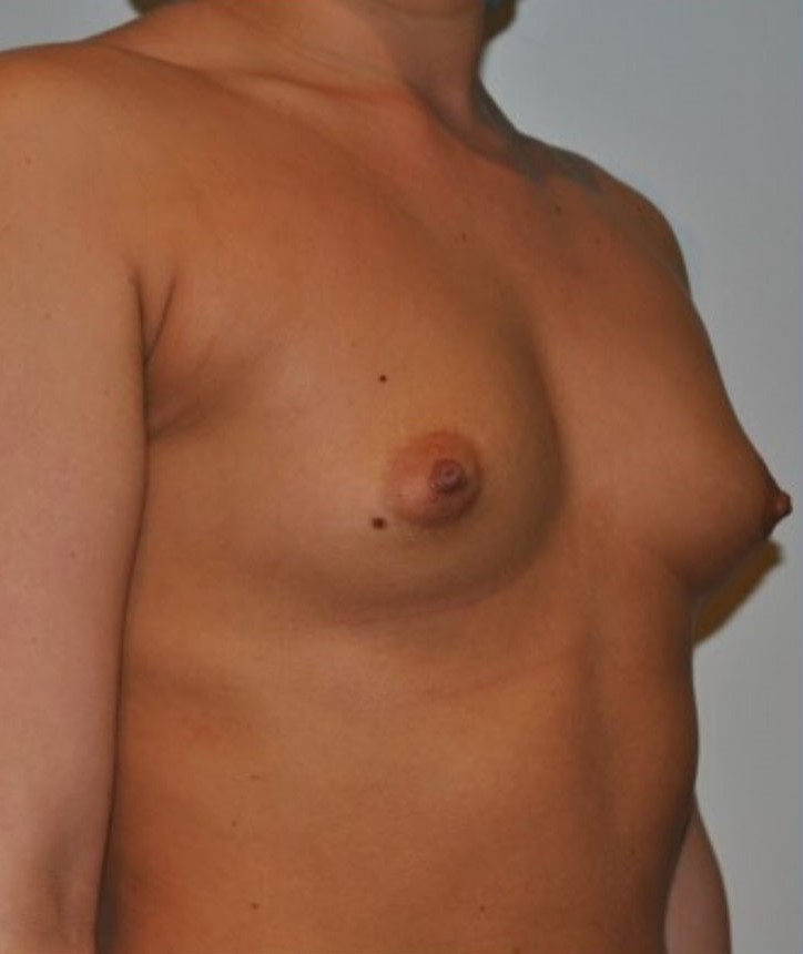 Before Image: Breast Augmentation - right-front-oblique
