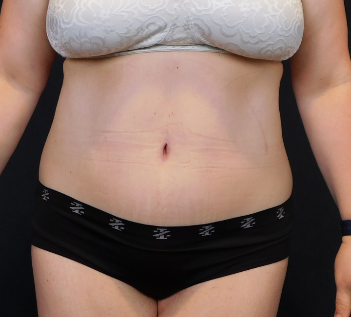 After Image: Tummy Tuck - front