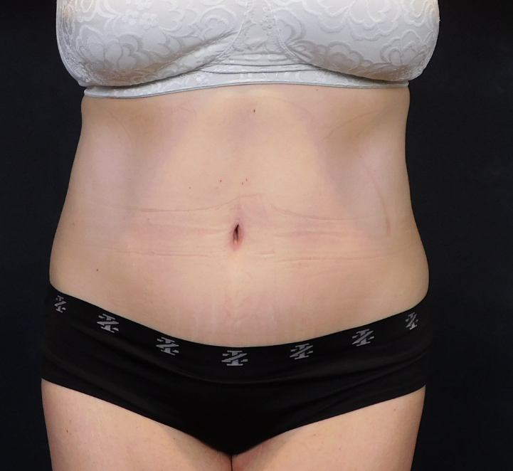 After Image: Tummy Tuck - front
