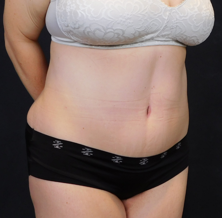 After Image: Tummy Tuck - right-front-oblique