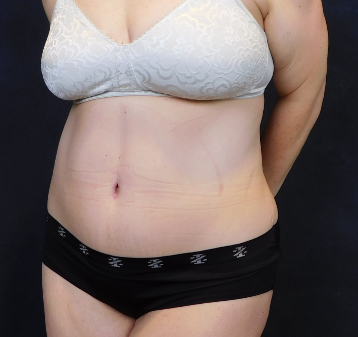 After Image: Tummy Tuck - left-front-oblique