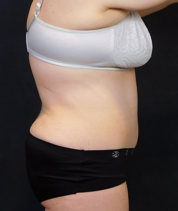 After Image: Tummy Tuck - right-side