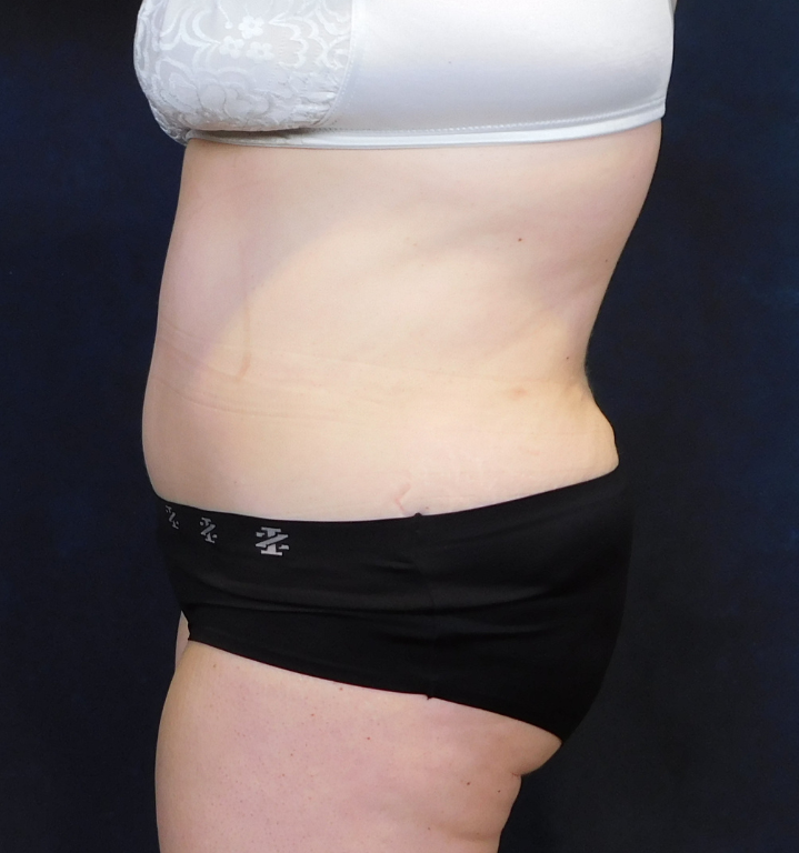 After Image: Tummy Tuck - left-side