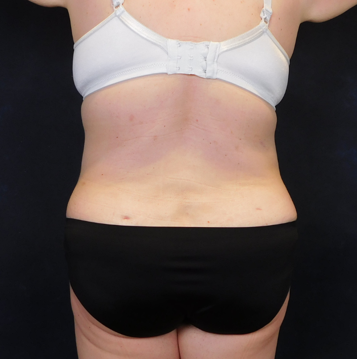 After Image: Tummy Tuck - back