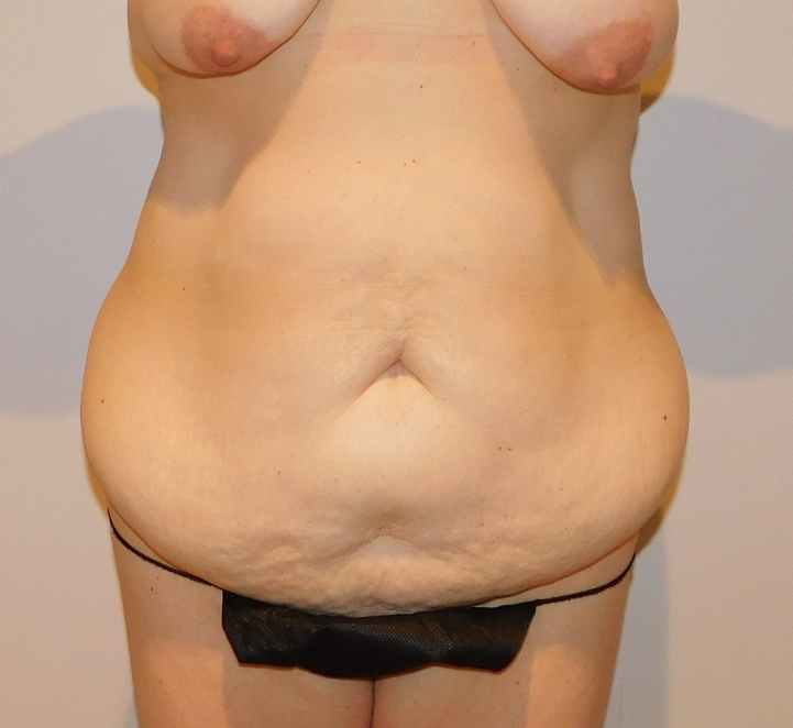 Before Image: Tummy Tuck - front