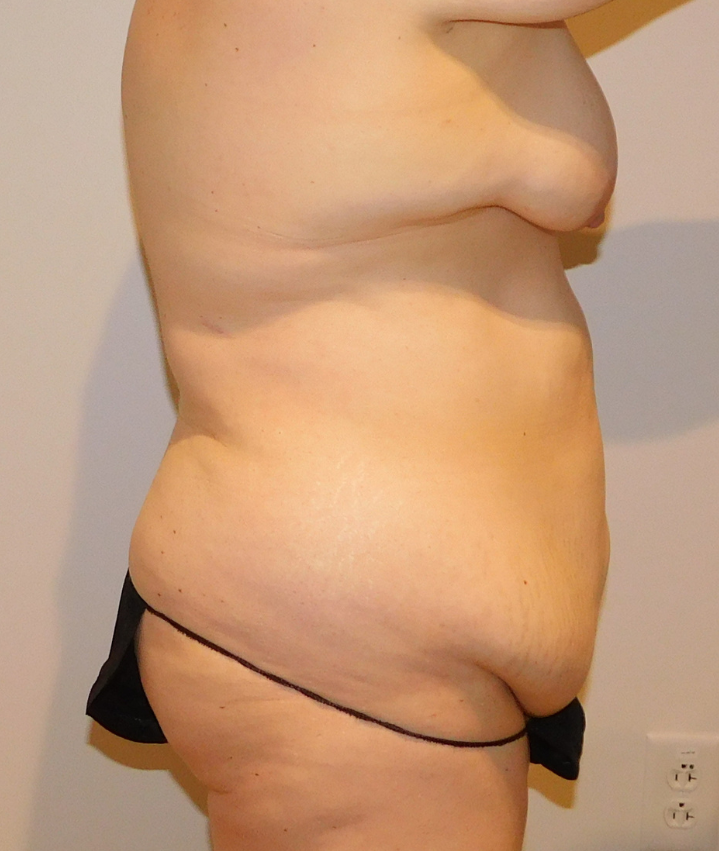 Before Image: Tummy Tuck - right-side