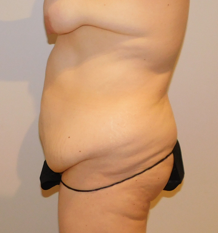 Before Image: Tummy Tuck - left-side
