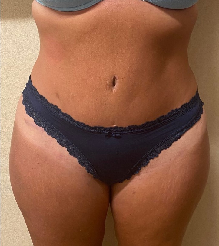 After Image: Tummy Tuck - front