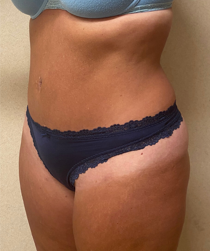 After Image: Tummy Tuck - left-front-oblique