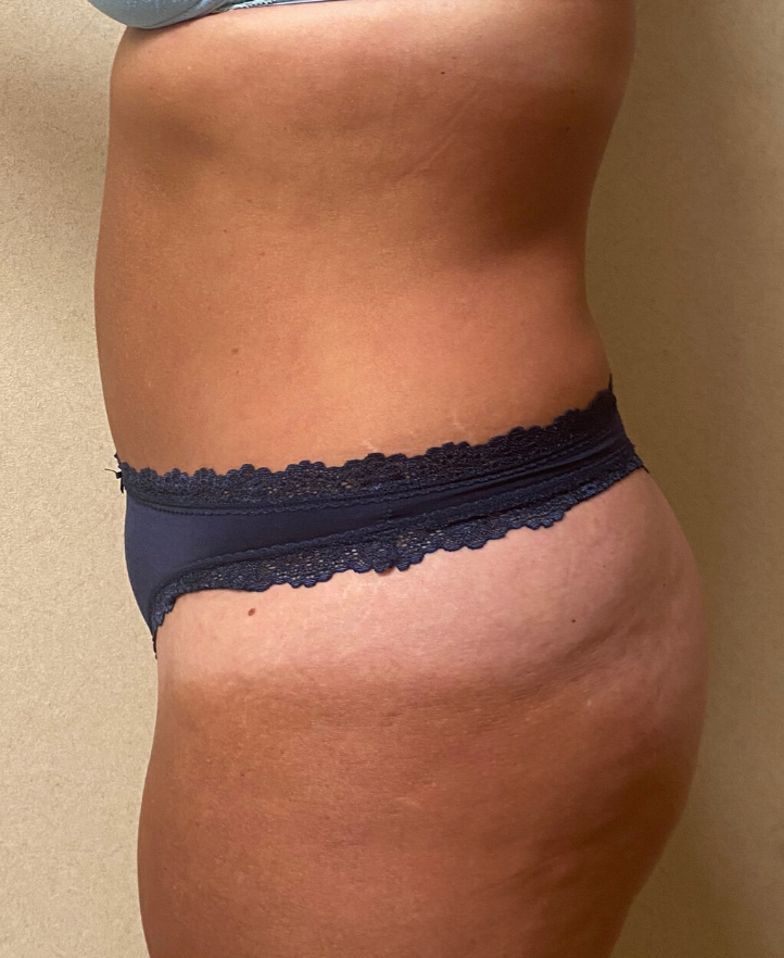 After Image: Tummy Tuck - left-side