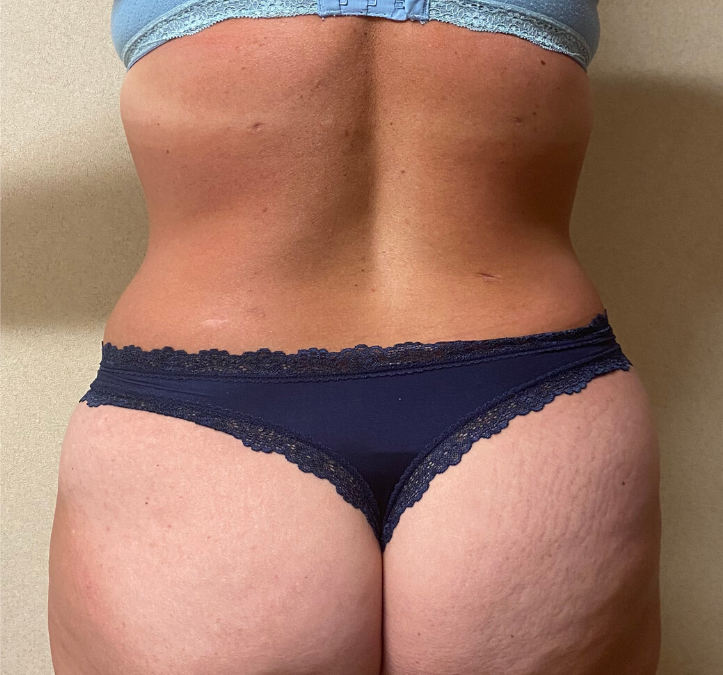 After Image: Tummy Tuck - back