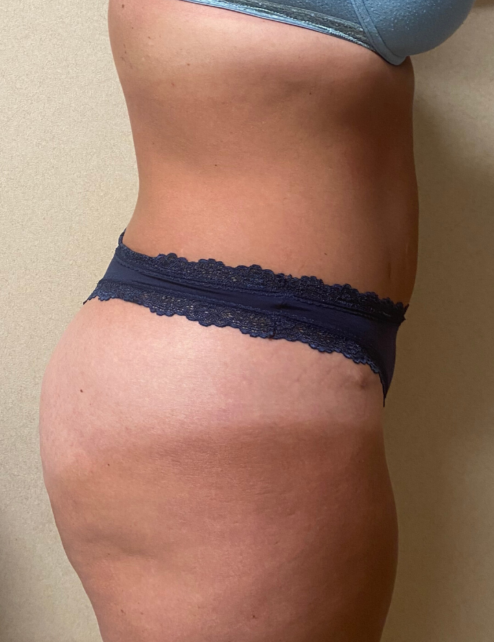 After Image: Tummy Tuck - right-side