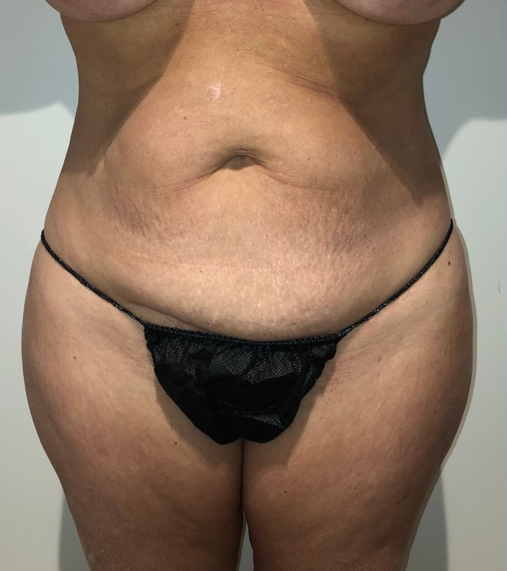 Before Image: Tummy Tuck - front